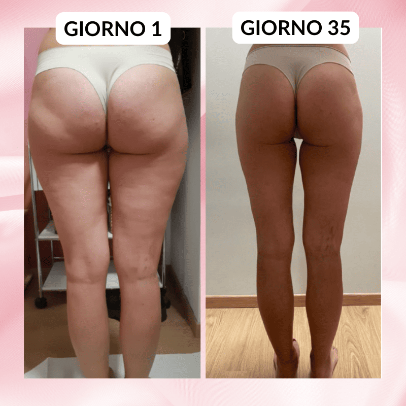 HealthyCellulite