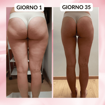 HealthyCellulite